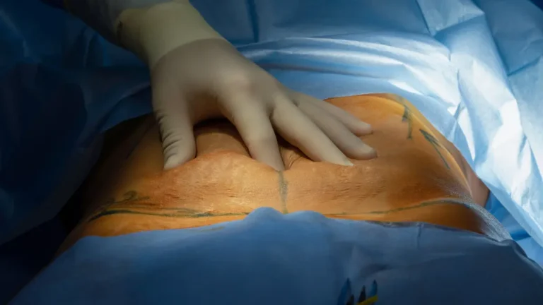 Como e feita a abdominoplastia
